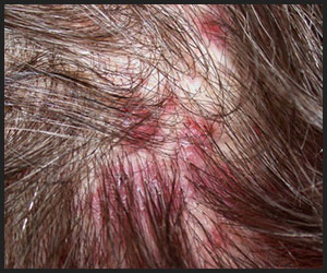 Damaged Scalp Damaged Scalp